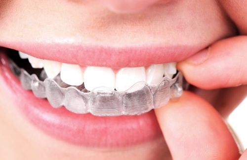 invisalign_single